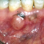 clinical pathology gums