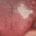 clinical pathology tongue